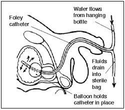drawing showing placement of the Foley catheter