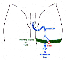 reduced image of drawing to show how to tape the catheter to the leg