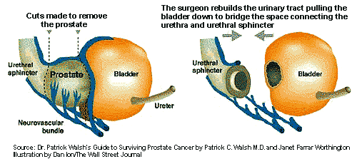 drawing showing how the prostate is removed