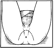 drawing showing where the incision is made
