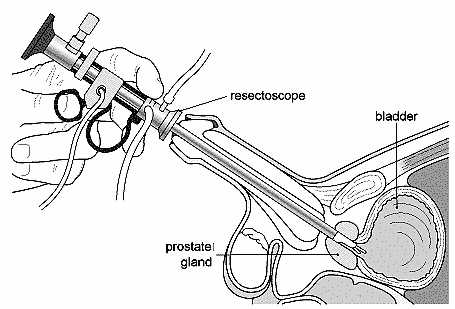 drawing of resectoscope in use