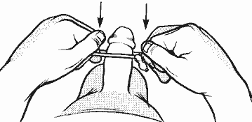 illustration of the procedure