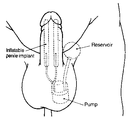 line drawing of the procedure