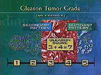 frame from video showing how gleason grades are given