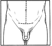 line drawing showing where incision for retropubic is made 
