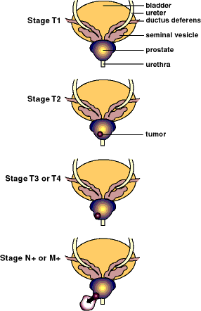 illustration of different stages of cancer in the prostate