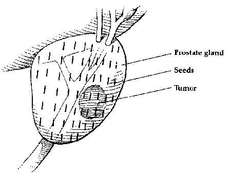 line drawing showing the placement of seeds in a prostate