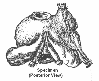 second half of Figure 6 of the nerve-sparing radical retropubic prostatectomy RRP technicque of Dr. Patrick Walsh