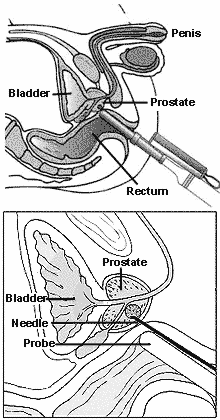 drawing showing a biopsy of the prostate