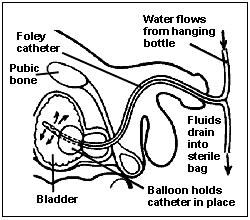 line drawing of a foley catheter in place