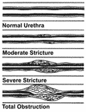 diagram showing severity of urethral strictures
