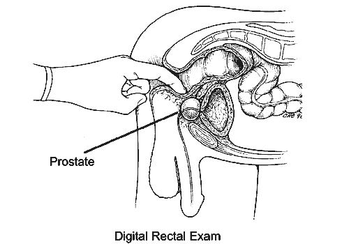 line drawing showing how a digital rectal exam is done to feel the prostate for any palpable abnormalities