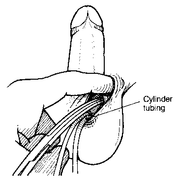line drawing of the procedure